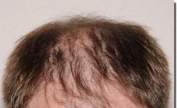 Hair restoration procedure results