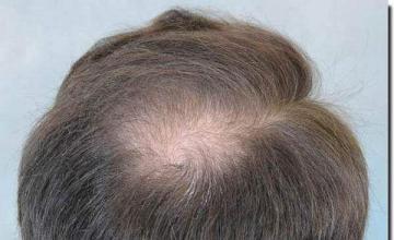 Hair restoration procedure results