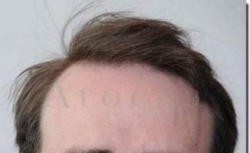 Hair restoration procedure results