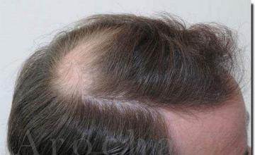 Hair restoration procedure results