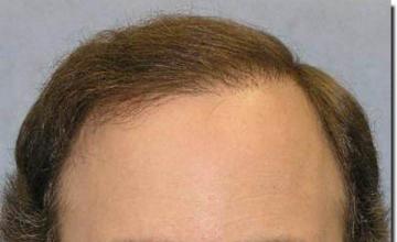 Hair restoration procedure results
