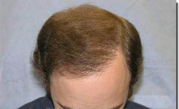 Hair restoration procedure results