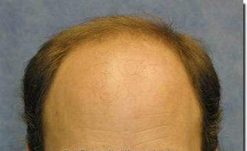 Hair restoration procedure results