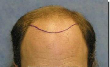 Hair restoration procedure results