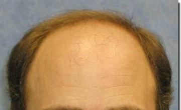 Hair restoration procedure results