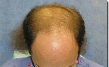 Hair restoration procedure results