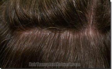 Hair restoration procedure results