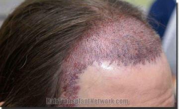 Hair restoration procedure results