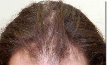 Hair restoration procedure results