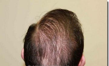 Hair restoration procedure results