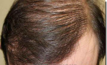 Hair restoration procedure results