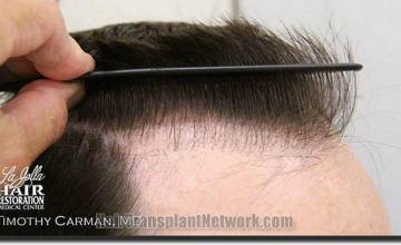 Hair restoration procedure results