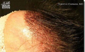 Hair restoration procedure results