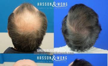 Surgical hair transplantation result photographs