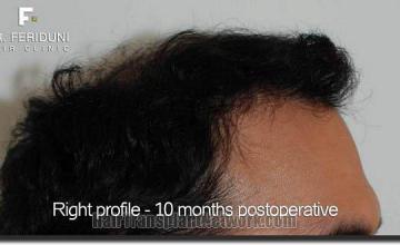 Hair restoration procedure results