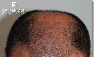 Hair restoration procedure results