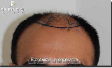 Hair restoration procedure results