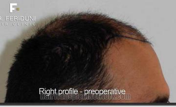 Hair restoration procedure results