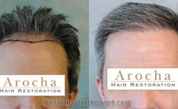 Hair restoration procedure before and after results