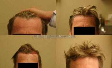 Hair restoration procedure before and after results