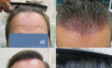 Hair transplantation surgery before and after images