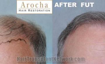 Hair transplantation surgery before and after photos