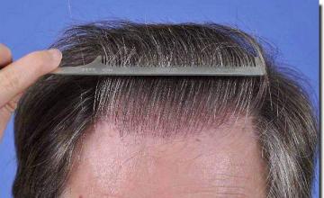 Hair restoration procedure results