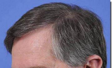 Hair restoration procedure results