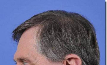 Hair restoration procedure results