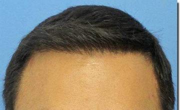 Hair restoration procedure results