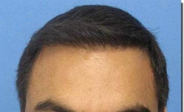 Hair restoration procedure results