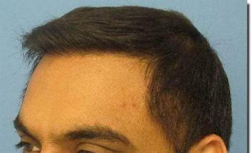 Hair restoration procedure results