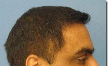 Hair restoration procedure results