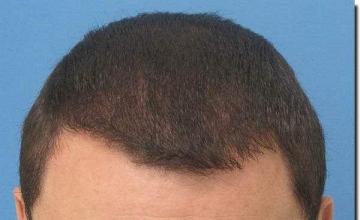 Hair restoration procedure results