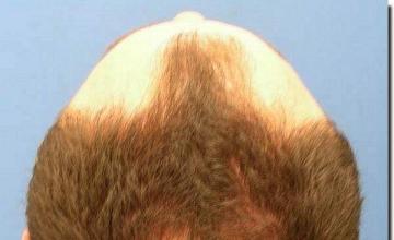 Hair restoration procedure results