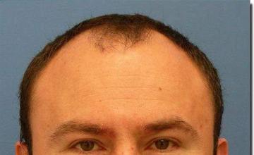 Hair restoration procedure results