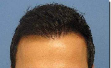 Hair restoration procedure results