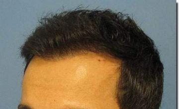 Hair restoration procedure results