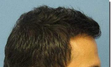 Hair restoration procedure results