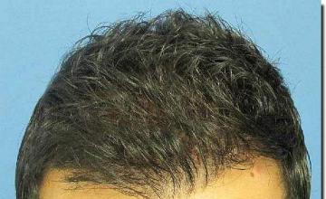 Hair restoration procedure results