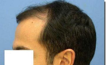 Hair restoration procedure results