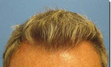 Hair restoration procedure results