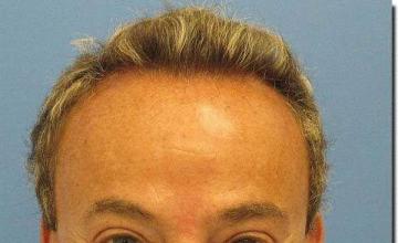 Hair restoration procedure results