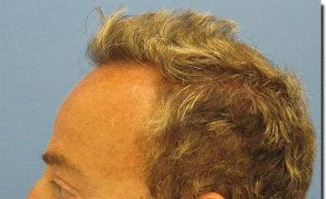 Hair restoration procedure results