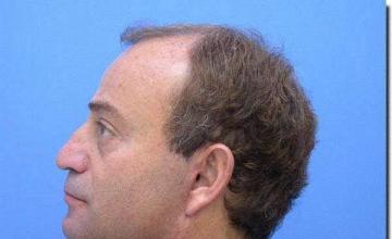 Hair restoration procedure results