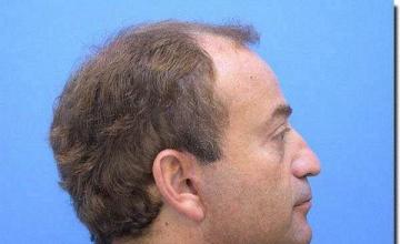 Hair restoration procedure results