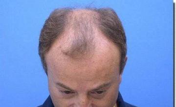 Hair restoration procedure results