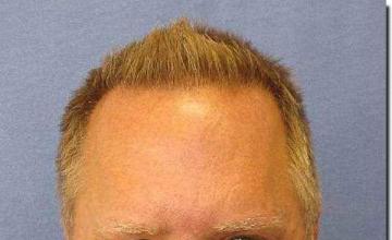 Hair restoration procedure results