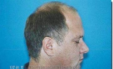 Hair restoration procedure results