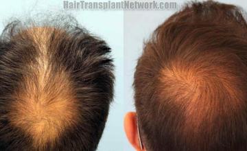 Hair transplantation surgery before and after photos